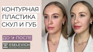 УВЕЛИЧИВАЕМ ГУБЫ. Результат ДО и ПОСЛЕ. Контурная пластика Скул и Губ. Какой Препарат Выбрать?