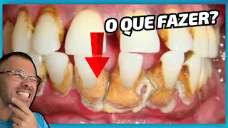 O QUE SÃO TÁRTAROS? COMO TIRAR EM CASA? FAÇA ISSO!