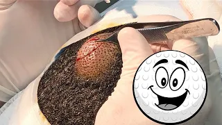 Giant Scalp Cyst Busted! Simply Enormous