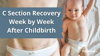 C Section Recovery Week by Week (After Childbirth Recovery Course Lesson 5)