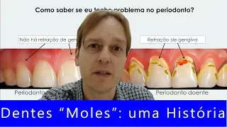 Dentes Moles - Uma História Dramática de Periodontite [Mas Poderia Ter Sido Bem Pior!]: Você Já Viu?