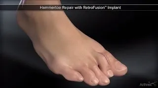 Hammertoe Repair with RetroFusion™ Implant