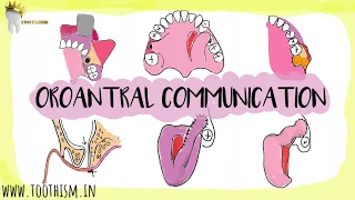 Oroantral Communication AND Fistula | Treatment options | Oral Surgery