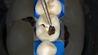 how to remove cavity from tooth ll #shorts