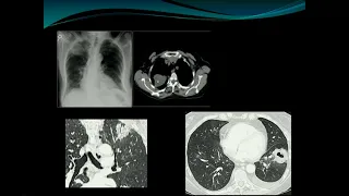 Stratification of lung nodules and the new Fleischner guidelines - Theresa McLoud