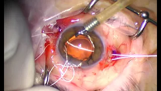Aphakia to Vision with Scleral Fixation of Intraocular Lens using Gore-tex sutures
