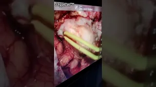 #20220409 StypCel™ in meningioma resection surgery