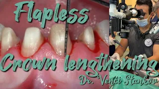 Crown lengthening technique. Dr. Venci Stankov