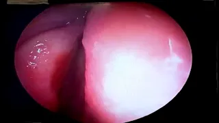 Sphenoid sinus medial approach