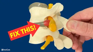 How to Relieve Herniated Disc Pain in SECONDS