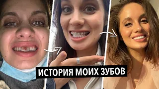 МОЯ ИСТОРИЯ ЗУБОВ | ВИНИРЫ, БРЕКЕТЫ, КОРОНКИ, УДАЛЕНИЕ