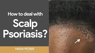 Beat Scalp Psoriasis: Tips and Tricks for Relief