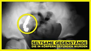 5 seltsame Gegenstände, die in menschlichen Körpern gefunden wurden