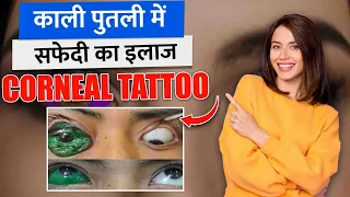 Corneal Opacity आँख में सफेदी | Corneal Opacity Causes and Treatment | Corneal Opacity in Hindi