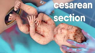 A cesarean section | known as a C-section |  is a surgery to deliver a baby via the abdomen