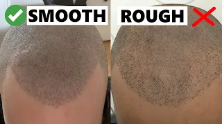 Buzz Cut after a Correct vs Failed Hair Transplant!