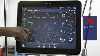 Initial Ventilator Management: Severe obstructive lung disease