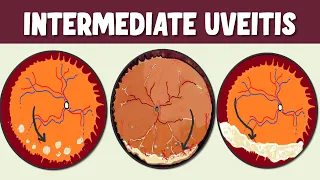 Intermediate Uveitis: Spotlight on Symptoms, Signs, and Potential Complications