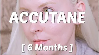 6 Months on Accutane | Halfway??