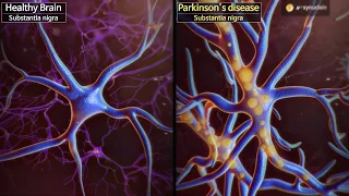 Wake up dormant dopaminergic neurons to reverse Parkinson’s disease