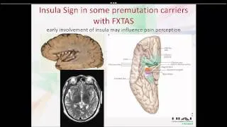 Let's Talk Fragile X Premutation Carriers and Health