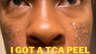 I got a 15 percent tca peel ( my chemical peel experience )