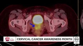 Woman pleads for Utahns to get HPV vaccine to prevent cervical cancer