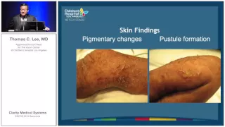 Dr. Thomas Lee: Wide Field Fluorescein Angiography for Pediatric Retinal Disease