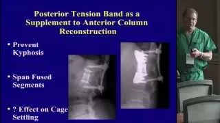 Posterior MIS: Trauma Thoracolumbar Decompression & Instrumentation by Mark B. Dekutoski, M.D.