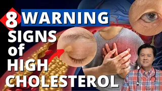 8 Warning Signs of High Cholesterol