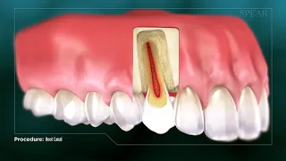 What Is Root Canal Treatment?