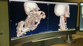 Mal de Debarquement Syndrome and Upper Cervical Instability