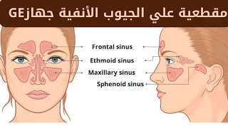 شرح تظبيط حاله مقطعية علي الجيوب الانفية  PNS علي جهاز GE والافلام اللي بنطبعها