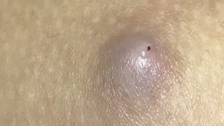 big cyst