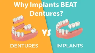 Dentures Versus Dental Implants: Which is Right for You? | DentaVacation