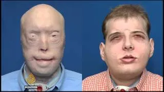 The most extensive face transplant