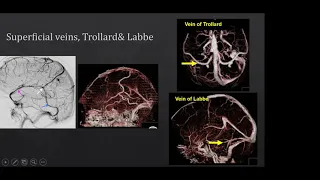 Venous anatomy of Brain, CTV, MRV and DSA.