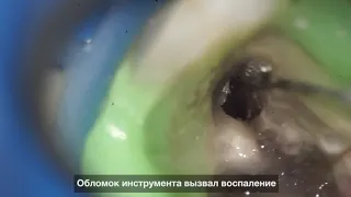 Извлечение обломка инструмента из зубного канала под микроскопом