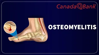 Osteomyelitis