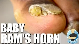 CRAZY SPLIT NAIL RAM'S HORN TOENAIL REMOVAL