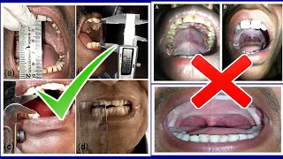 Munh Kaise Khule Ga । OSMF treatment in Hindi । Sub mucous Fibrosis @dramitkdubey