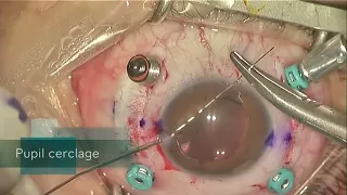 Aphakia after congenital cataract surgery. IOL implantation + Iris reconstruction.