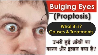 What is Bulging Eyes (Proptosis): Causes & Treatments | उभरी हुई आंखों का असल कारण क्या है?