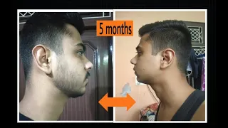 minoxidil beard 5 months results journey