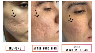 Subcision + Filler for Acne Scars