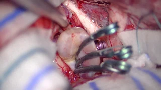 Microsurgical Clipping of Large Anterior Communicating Artery Aneurysm