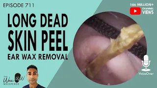 711 - Long Dead Skin Peel Ear Wax Removal