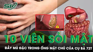 Phát Hiện Hơn 10 Viên Sỏi Và Nhiều Mủ Đặc Trong Ống Mật Chủ Của Cụ Bà 72 Tuổi | SKĐS