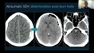 SPINAL CSF LEAKS: UPDATES IN DIAGNOSIS AND MANAGEMENT. HOW CAN YOUR NEURORADIOLOGIST HELP YOU?