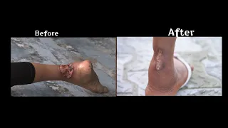 MUST WATCH: Severe Leg Ulcer Healed Instantly